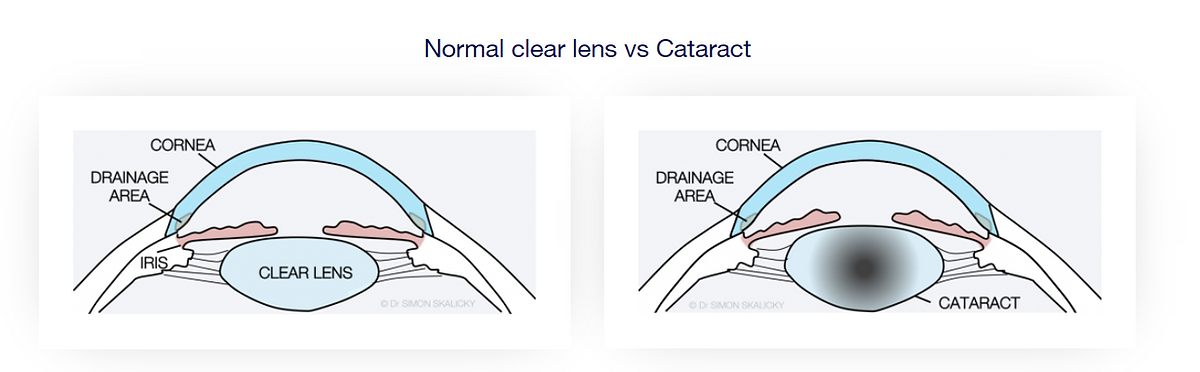What is Cataract