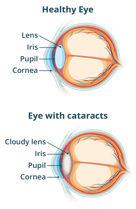 Cataract Treatment