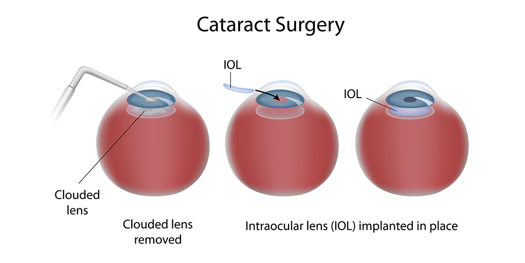 Cataract Surgery