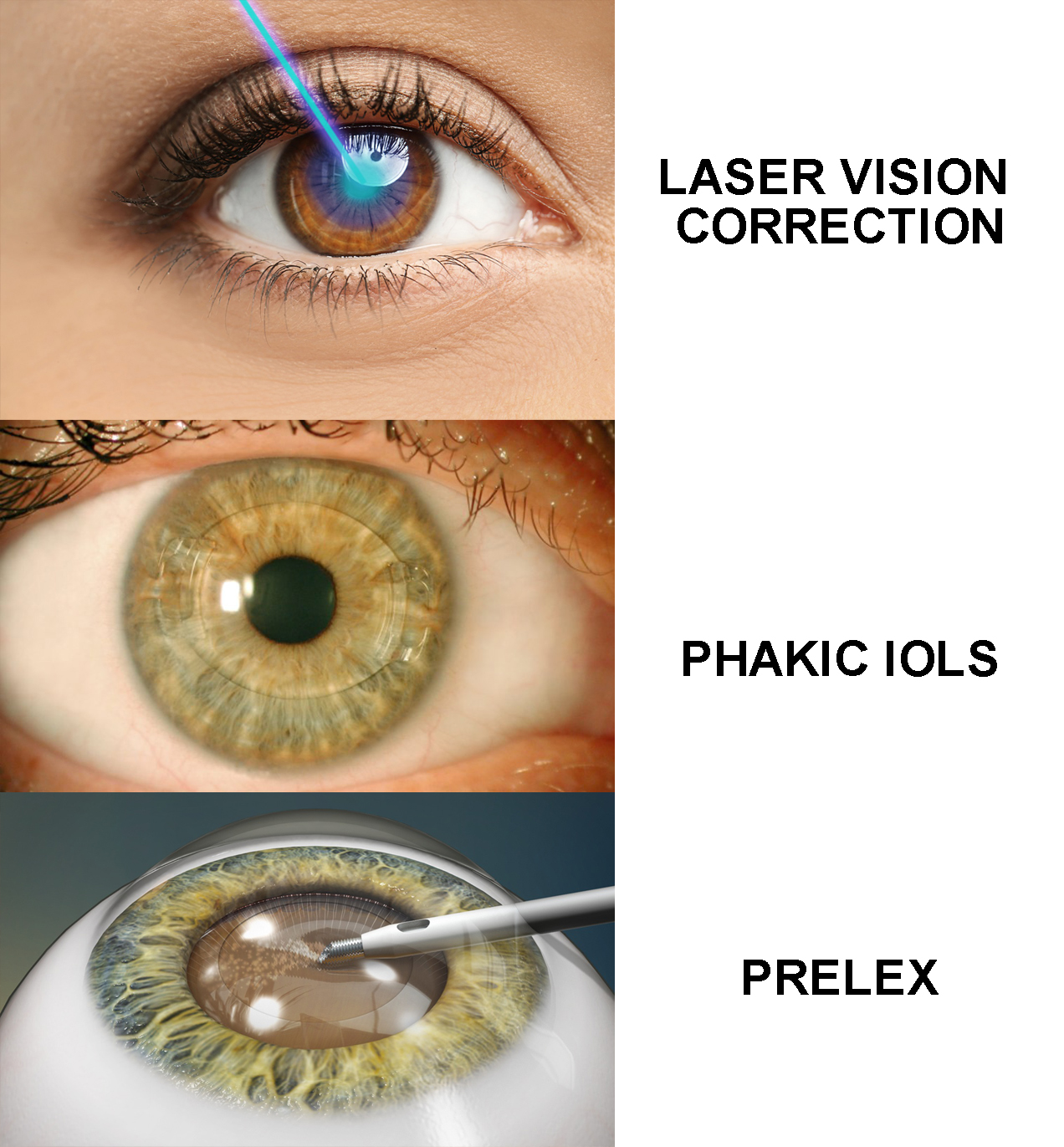 Refractive Surgery