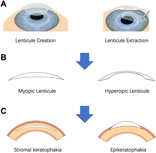 Lenticule Extraction